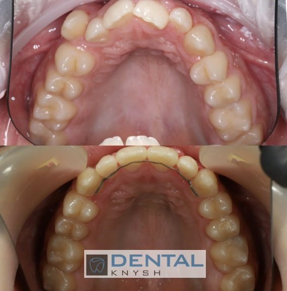 Fotorelacja: efekty leczenia w gabinecie DentalKnysh, aparaty ortodontyczne na zęby, lek. Waleria Bonar, 2025-10-21 zdjęcie 4