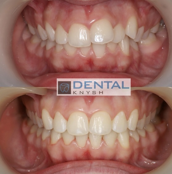 Fotorelacja: efekty leczenia w gabinecie DentalKnysh, aparaty ortodontyczne na zęby, lek. Waleria Bonar, 2025-10-21 zdjęcie 5