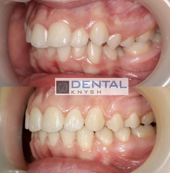 Fotorelacja: efekty leczenia w gabinecie DentalKnysh, aparaty ortodontyczne na zęby, lek. Waleria Bonar, 2025-10-21 zdjęcie 6