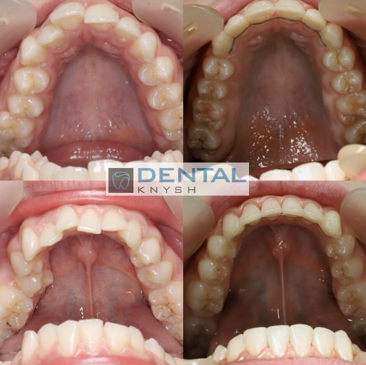 Fotorelacja: efekty leczenia w gabinecie DentalKnysh, aparaty ortodontyczne na zęby, lek. Waleria Bonar, 2025-10-21 zdjęcie 7