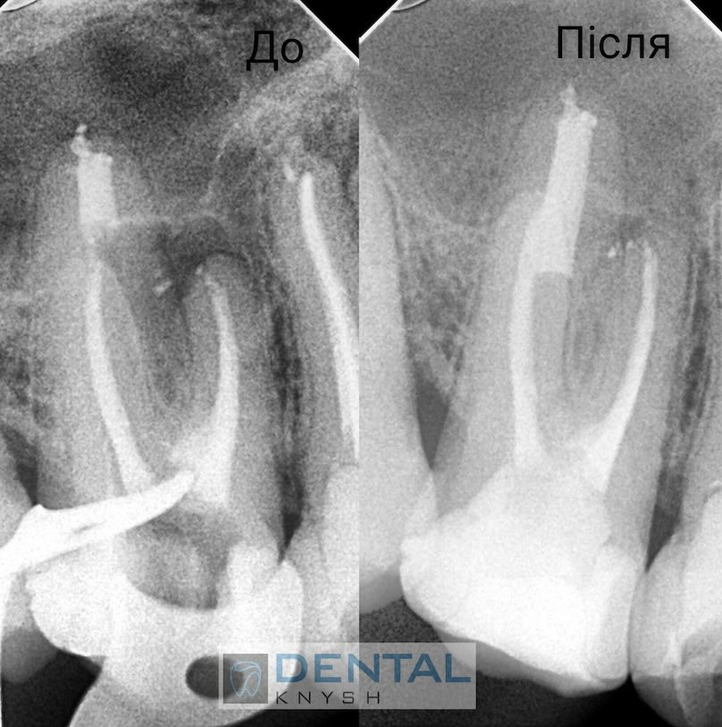 Leczenie kanałowe zębów pod mikroskopem w DentalKnysh, dr Dmytro Kushinsky 2025-10-21, tomografia komputerowa - 1