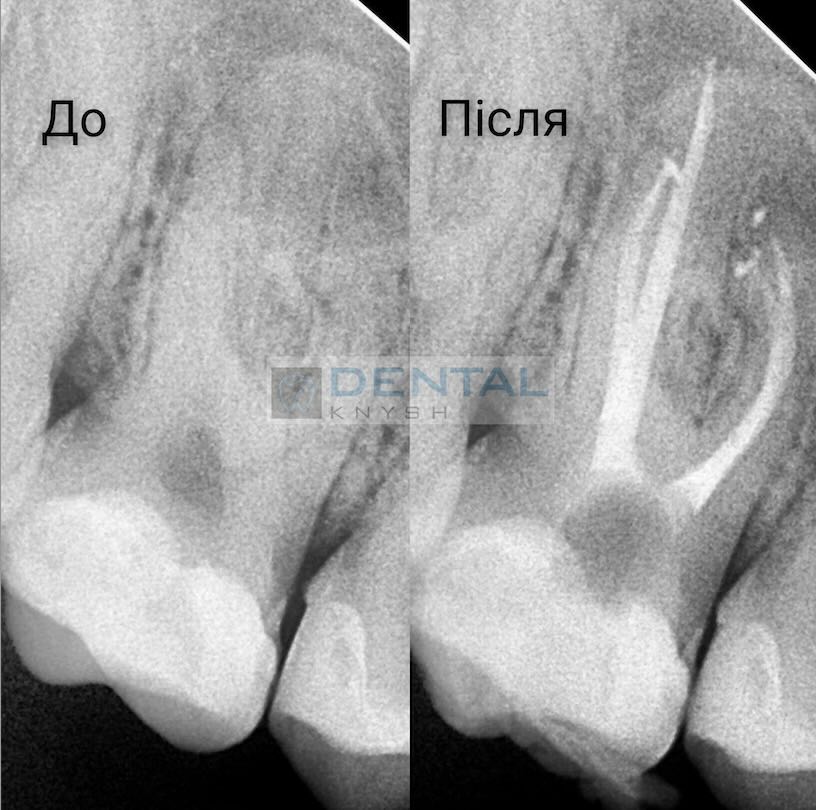 Leczenie kanałowe zębów pod mikroskopem w DentalKnysh, dr Dmytro Kushinsky 2025-10-21, tomografia komputerowa - 2