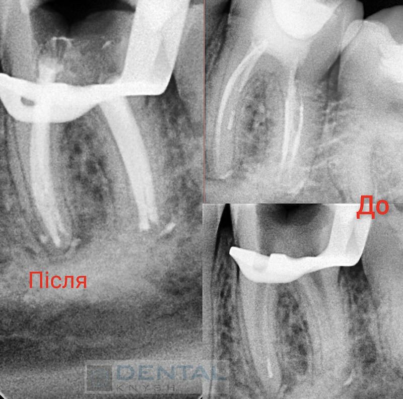 Leczenie kanałowe zębów pod mikroskopem w DentalKnysh, dr Dmytro Kushinsky 2025-10-21, tomografia komputerowa - 3