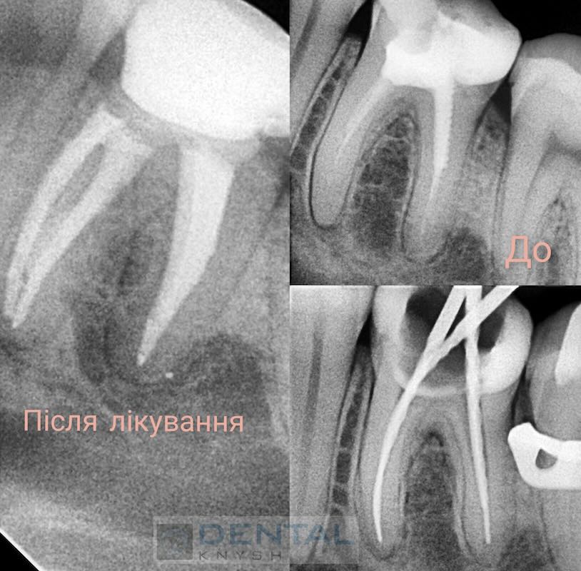 Leczenie kanałowe zębów pod mikroskopem w DentalKnysh, dr Dmytro Kushinsky 2025-10-21, tomografia komputerowa - 4