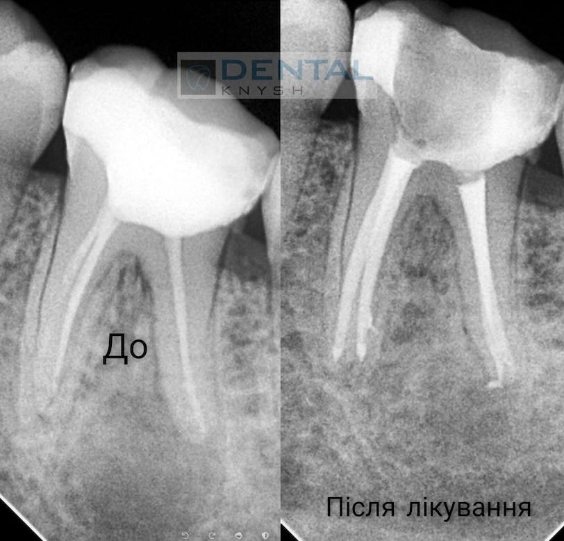 Leczenie kanałowe zębów pod mikroskopem w DentalKnysh, dr Dmytro Kushinsky 2025-10-21, tomografia komputerowa - 5