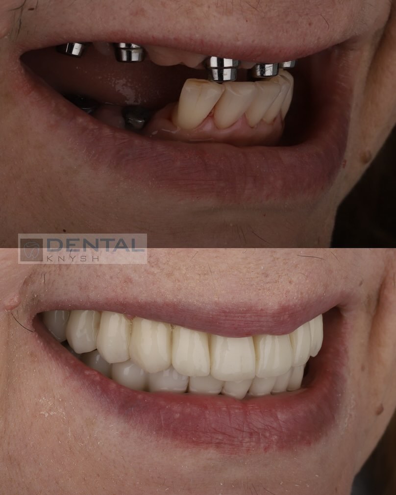 Fotorelacja: efekty leczenia w DentalKnysh, implantacja zębów, dr Igor Igorovich Knysh, 2025-10-21 zdjęcie 1