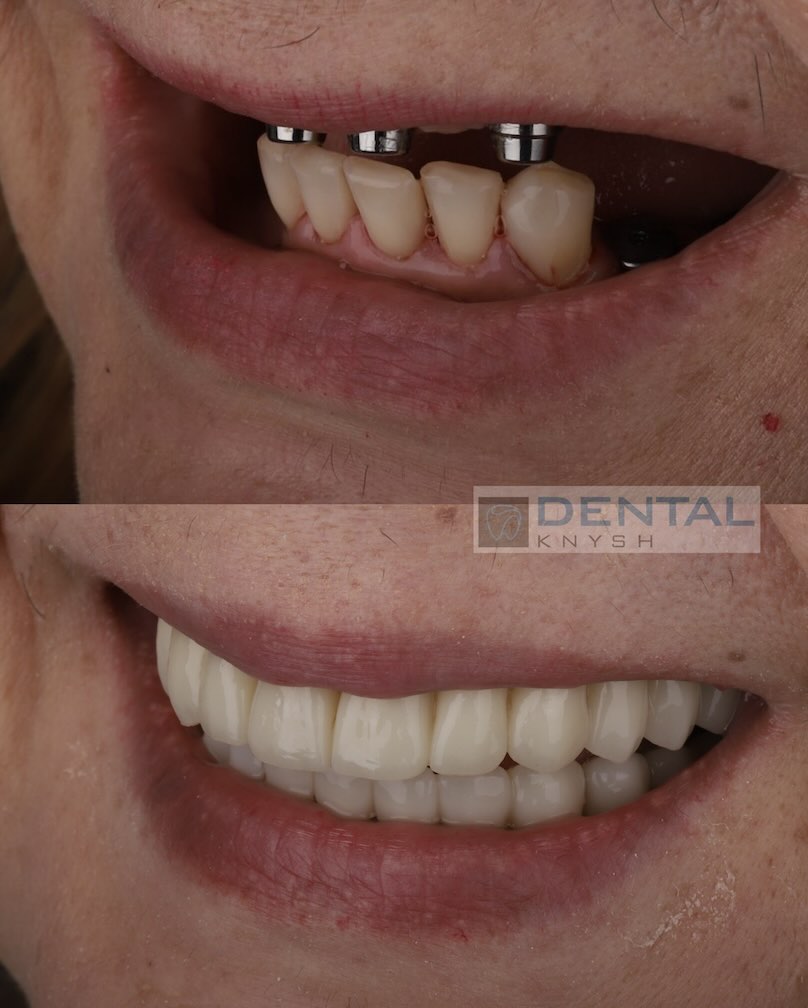 Fotorelacja: efekty leczenia w DentalKnysh, implantacja zębów, dr Igor Igorovich Knysh, 2025-10-21 zdjęcie 2