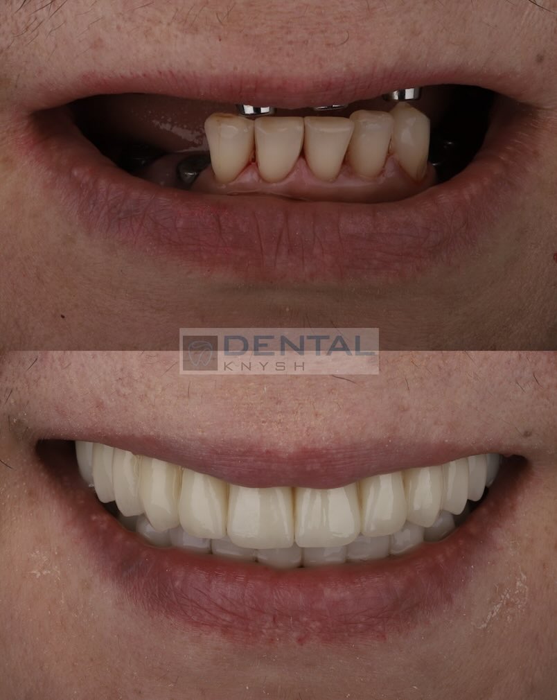 Fotorelacja: efekty leczenia w DentalKnysh, implantacja zębów, dr Igor Igorovich Knysh, 2025-10-21 zdjęcie 3