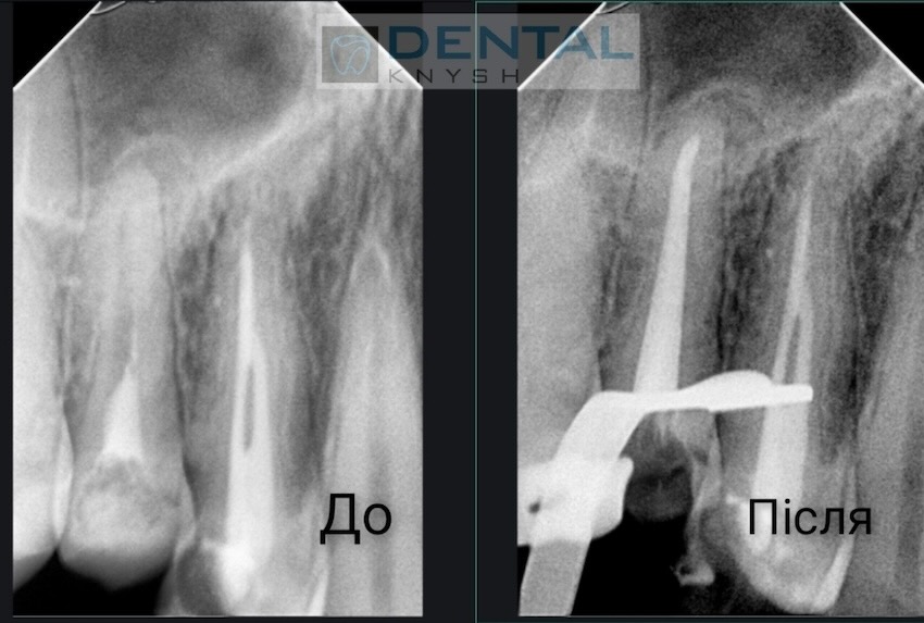 Фото звіт лікування зубних каналів в DentalKnysh, лікар Вадим Петриченко, 2025-10-28 скрін 21
