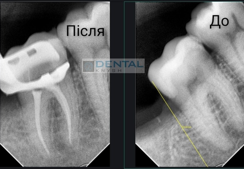 Фото звіт лікування зубних каналів в DentalKnysh, лікар Вадим Петриченко, 2025-10-28 скрін 22