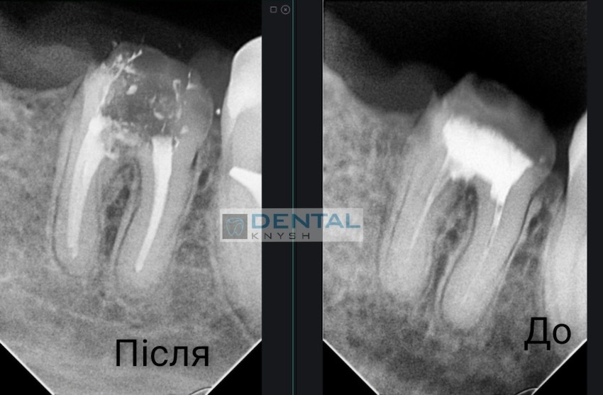 Фото звіт лікування зубних каналів в DentalKnysh, лікар Вадим Петриченко, 2025-10-28 скрін 24