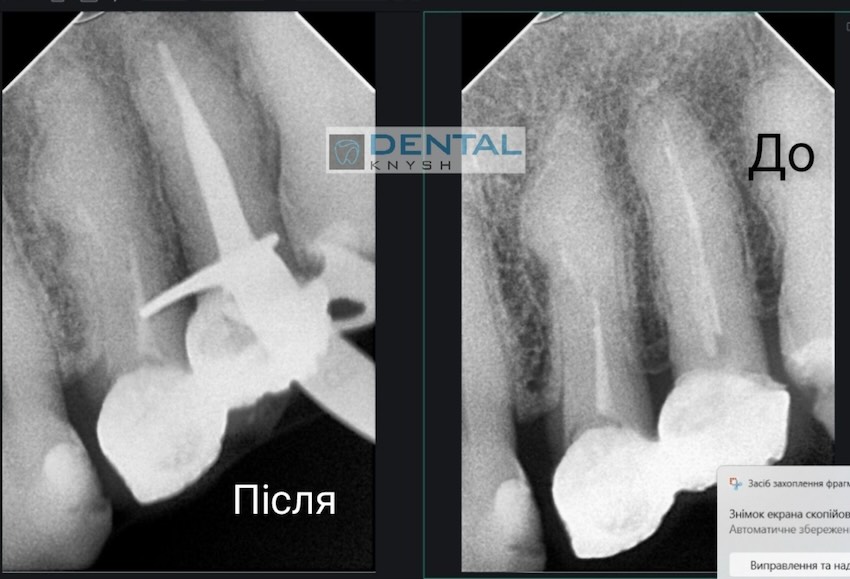 Фото звіт лікування зубних каналів в DentalKnysh, лікар Вадим Петриченко, 2025-10-28 скрін 25