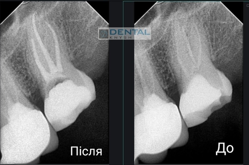 Фото звіт лікування зубних каналів в DentalKnysh, лікар Вадим Петриченко, 2025-10-28 скрін 26