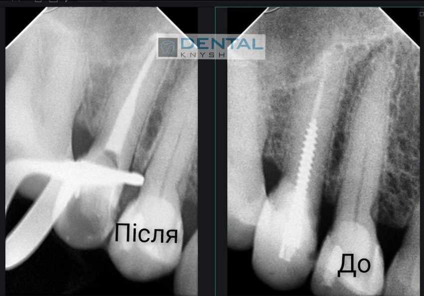 Фото звіт лікування зубних каналів в DentalKnysh, лікар Вадим Петриченко, 2025-10-28 скрін 27