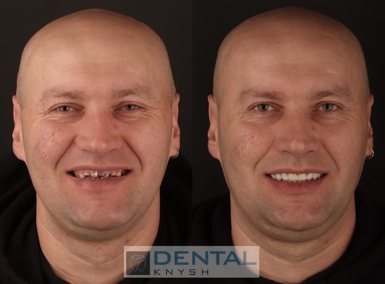 Фото отчет: имплантация зубов, коронки, фото до/после, публикуется с разрешения пациента, 2025-12-14