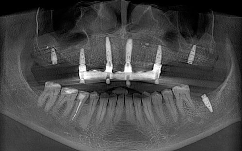 Полная Имплантация зубов верхней челюсти 14 коронок на 6 имплантах в DentalKnysh, 2026-01-12, скрин КТ
