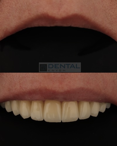 Полная Имплантация зубов верхней челюсти 14 коронок на 6 имплантах в DentalKnysh, 2026-01-12, фото до /после