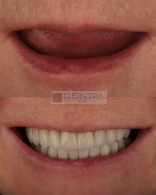 Фото отчет: all-on-4 - имплантация обеих челюстей в DentalKnysh - 24 коронки, фото публикуются с разрешения пациента, 2026-01-21, фото 1