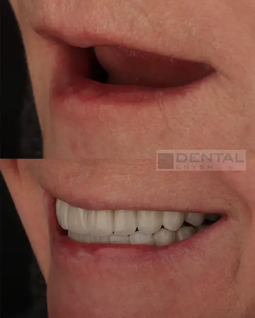 Фото отчет: all-on-4 - имплантация обеих челюстей в DentalKnysh - 24 коронки, фото публикуются с разрешения пациента, 2026-01-21, фото 3