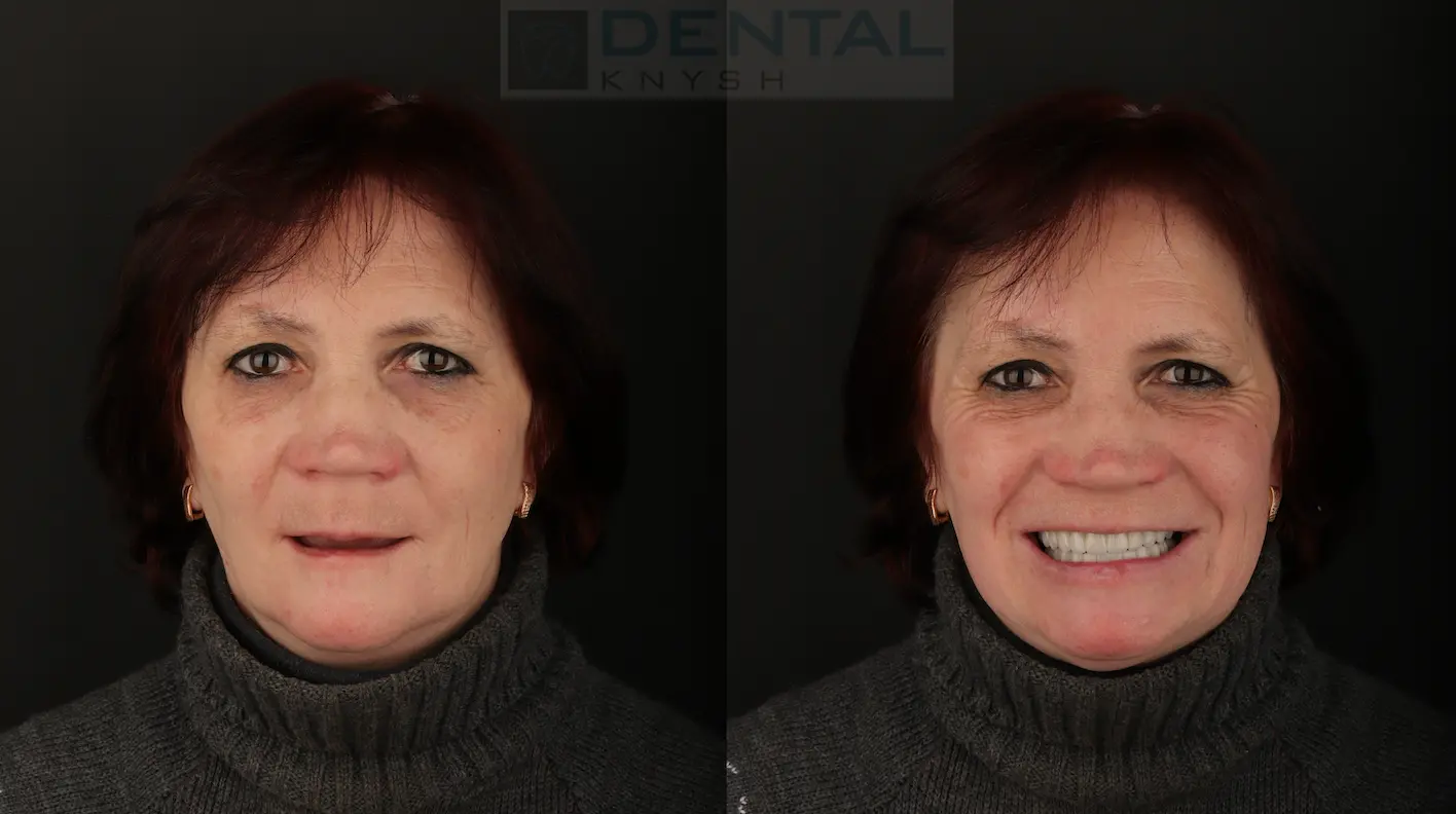 Фото отчет: полная имплантация зубов в DentalKnysh 2026-03-10, фото до/после
