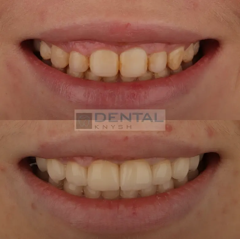 Фото-звіт: встановлення керамічних вінірів в DentalKnysh 2026-03-10 фото 1