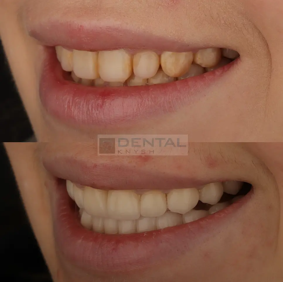 Фото-звіт: встановлення керамічних вінірів в DentalKnysh 2026-03-10 фото 2