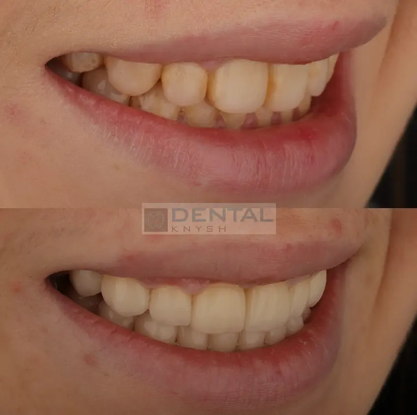 Фото-звіт: встановлення керамічних вінірів в DentalKnysh 2026-03-10 фото 3