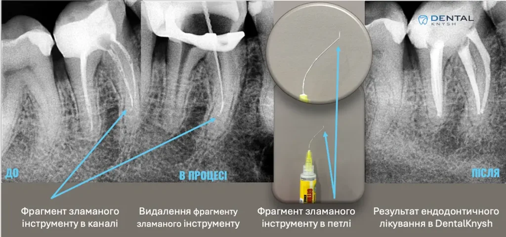 Фото-звіт ендодонтичного лікування в DentalKnysh: видалення фрагменту зламаного інструменту, 2026-04-12