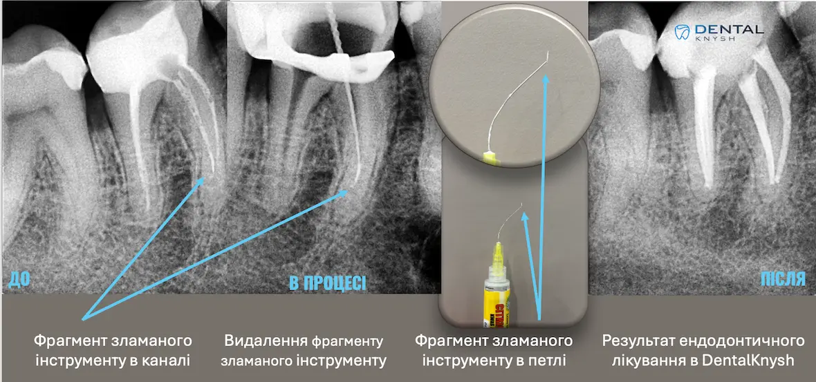 Фото-отчет эндодонтического лечения в DentalKnysh: удаление фрагмента сломанного инструмента, 2026-04-12