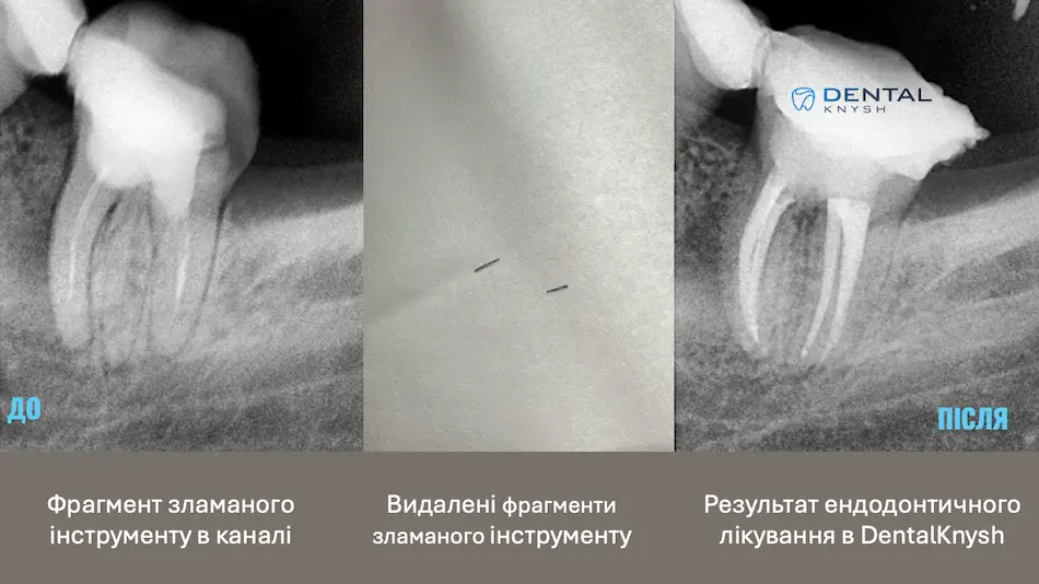 Фото-звіт ендодонтичного лікування в DentalKnysh: видалення фрагментів зламаного інструменту, 2026-04-14