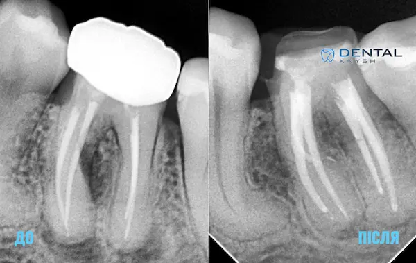 Фото-звіт ендодонтичного лікування в DentalKnysh, до/після, 2026-04-15