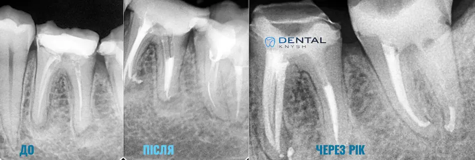 Фото-звіт ендодонтичного лікування: до/після, і через рік, DentalKnysh, 2026-04-16