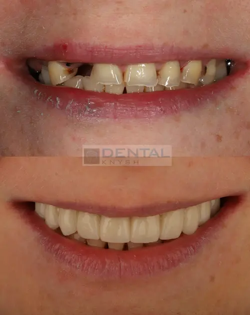 Фото-звіт: імплантація та керамічні вініри в DentalKnysh, 2026-04-12