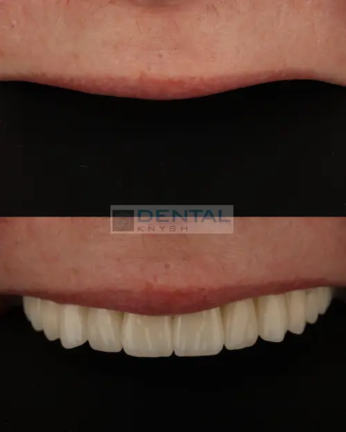 Фото-звіт: імплантація верхньої щелепи в DentalKnysh, 2026-04-12