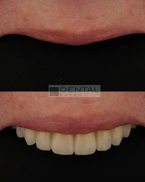 Фото-звіт: імплантація верхньої щелепи в DentalKnysh, 2026-04-13