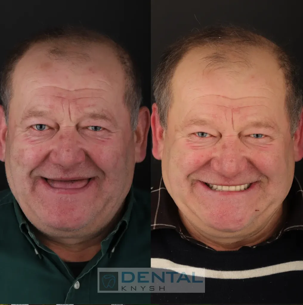 Фото звіт:  імплантація зубів верхньої щелепи в DentalKnysh 2026-04-14, фото до/після