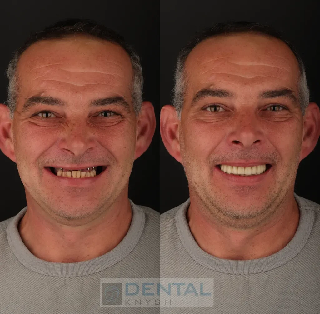 Фото звіт:  імплантація зубів верхньої щелепи в DentalKnysh 2026-04-15, фото до/після