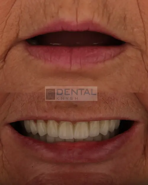  імплантація зубів верхньої щелепи в DentalKnysh 2026-04-17, фото 1