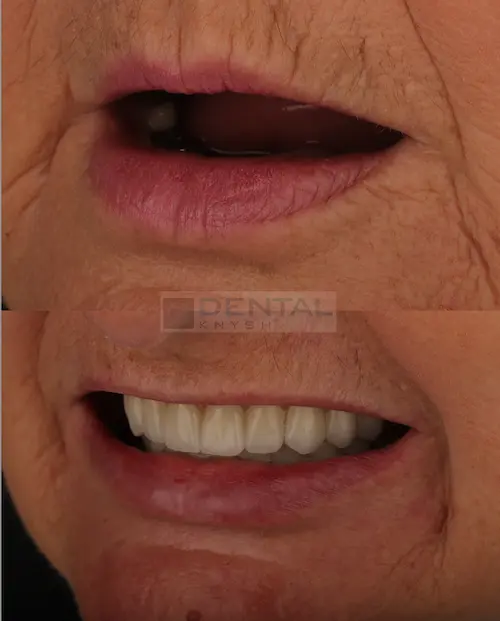  імплантація зубів верхньої щелепи в DentalKnysh 2026-04-17, фото 2