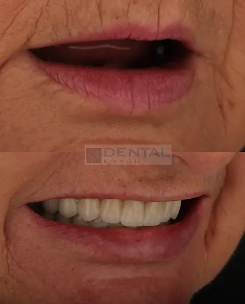  імплантація зубів верхньої щелепи в DentalKnysh 2026-04-17, фото 3