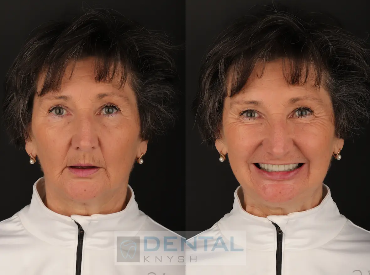 Фото отчет: имплантация зубов верхней челюсти в DentalKnysh 2026-04-17, фото в/после