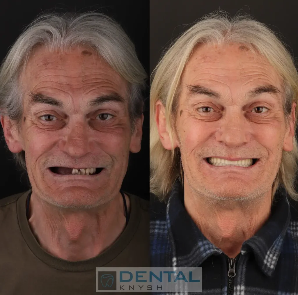 Фото звіт:  імплантація зубів верхньої щелепи в DentalKnysh 2026-04-17, фото до/після