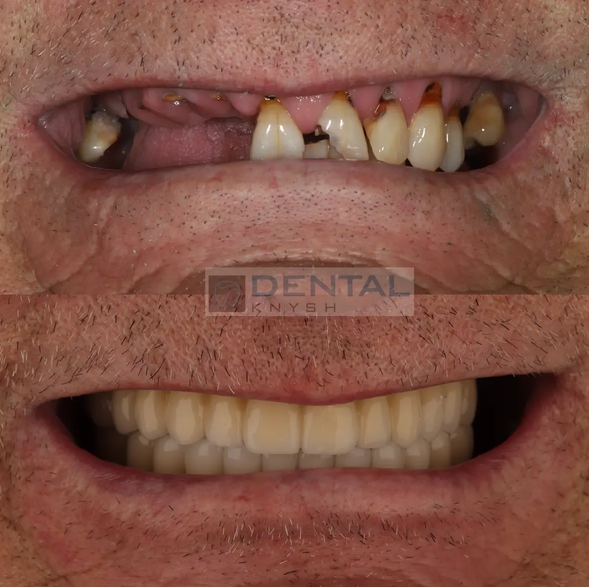 Имплантация зубов верхней челюсти в DentalKnysh 2026-04-17