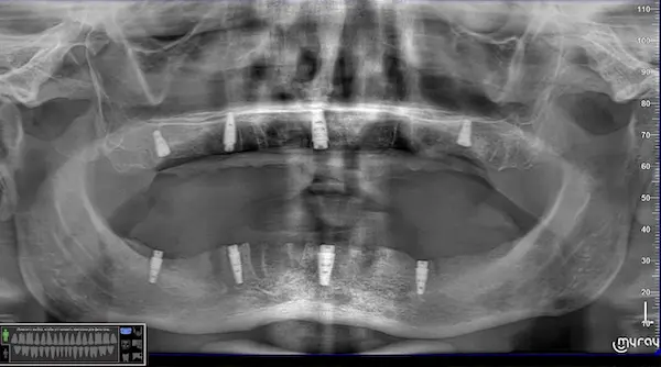 Скан КТ імплантації зубів в DentalKnysh, 2026-04-17
