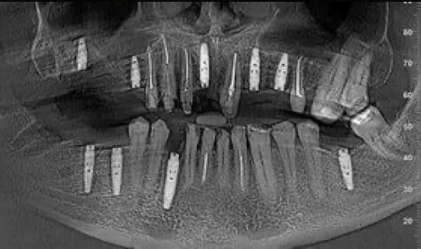 Імплантація зубів в DentalKnysh 2026-04-18 Скан КТ 1
