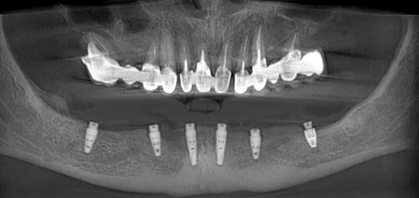 Фото звіт:  імплантація зубів верхньої щелепи в DentalKnysh 2026-04-17, фото до/після
