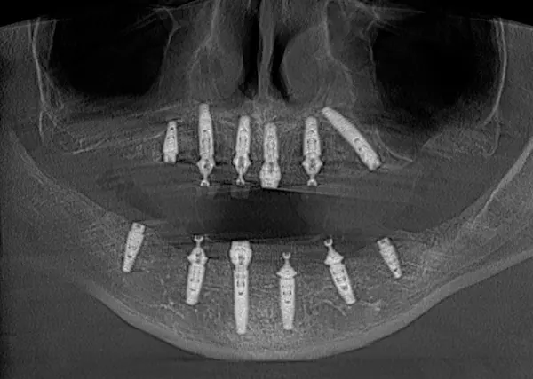 Імплантація зубів в DentalKnysh 2026-04-18 Скан КТ 3