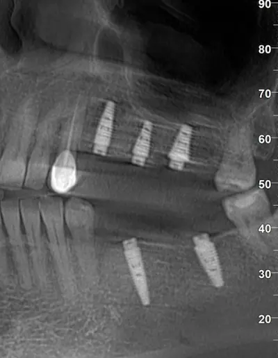 Скан КТ імплантації зубів в DentalKnysh, 2026-04-18