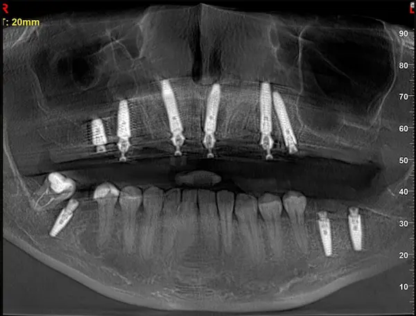 Імплантація зубів в DentalKnysh 2026-04-18 Скан КТ 5