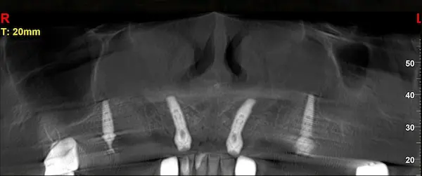 Імплантація зубів в DentalKnysh 2026-04-18 Скан КТ 6